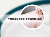 牛皮癣蔓延到脸上 牛皮癣往脸上起吗