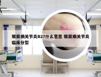 银屑病关节炎B27什么意思 银屑病关节炎临床分型