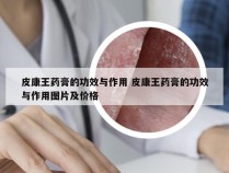 皮康王药膏的功效与作用 皮康王药膏的功效与作用图片及价格