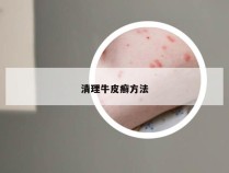 清理牛皮癣方法