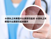 小孩头上长癣是什么原因引起的 小孩头上长癣是什么原因引起的图片
