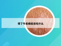 得了牛皮癣应该吃什么