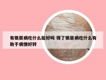 有银屑病吃什么能好吗 得了银屑病吃什么有助于病情好转
