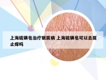 上海硫磺皂治疗银屑病 上海硫磺皂可以去屑止痒吗