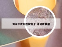 漯河牛皮癣医院那个 漯河皮肤病