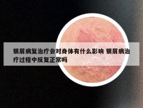 银屑病复治疗会对身体有什么影响 银屑病治疗过程中反复正常吗