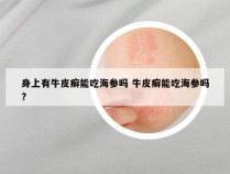 身上有牛皮癣能吃海参吗 牛皮癣能吃海参吗?