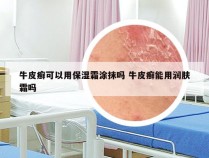 牛皮癣可以用保湿霜涂抹吗 牛皮癣能用润肤霜吗