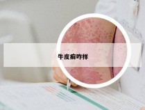 牛皮癣咋样