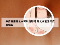牛皮癣用磁化水可以泡好吗 磁化水能治疗皮肤病么