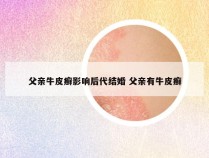 父亲牛皮癣影响后代结婚 父亲有牛皮癣