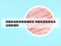 丙酸氯倍他索银屑病研究 丙酸氯倍他索乳膏治银屑病吗