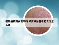 银屑病前期会发烧吗 银屑病加重引起发烧怎么办