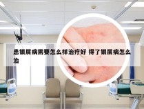 患银屑病需要怎么样治疗好 得了银屑病怎么治