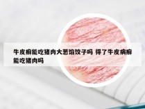 牛皮癣能吃猪肉大葱馅饺子吗 得了牛皮病癣能吃猪肉吗