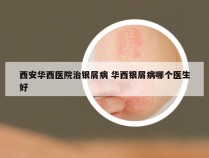 西安华西医院治银屑病 华西银屑病哪个医生好