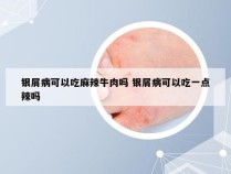 银屑病可以吃麻辣牛肉吗 银屑病可以吃一点辣吗
