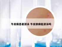 牛皮癣患者游泳 牛皮肤癣能游泳吗
