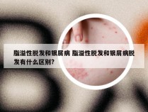 脂溢性脱发和银屑病 脂溢性脱发和银屑病脱发有什么区别?