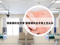 银屑病长在手掌 银屑病长在手掌上怎么办