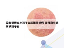 没有遗传史小孩子会起银屑病吗 父母没有银屑病孩子有