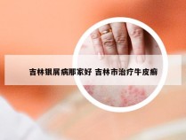 吉林银屑病那家好 吉林市治疗牛皮癣
