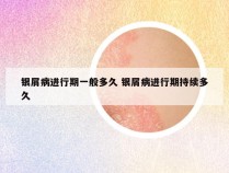 银屑病进行期一般多久 银屑病进行期持续多久