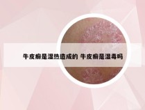 牛皮癣是湿热造成的 牛皮癣是湿毒吗