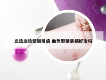 血热血热型银屑病 血热型银屑病好治吗