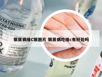 银屑病维C银翘片 银屑病吃维c有好处吗