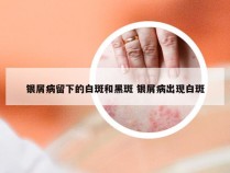 银屑病留下的白斑和黑斑 银屑病出现白斑