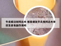 牛皮癣注射阿达木 银屑病关节炎用阿达木单抗生素有副作用吗
