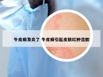 牛皮癣发炎了 牛皮癣引起皮肤红肿流脓