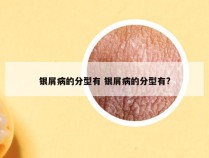银屑病的分型有 银屑病的分型有?
