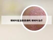 柳树叶能治银屑病吗 柳树叶治疗