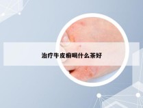 治疗牛皮癣喝什么茶好
