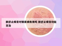 肤舒止痒膏对银屑病有用吗 肤舒止痒膏功能主治