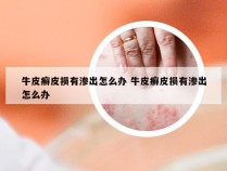牛皮癣皮损有渗出怎么办 牛皮癣皮损有渗出怎么办