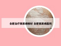 合肥治疗银屑病哪好 合肥银屑病医院