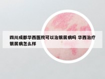 四川成都华西医院可以治银屑病吗 华西治疗银屑病怎么样