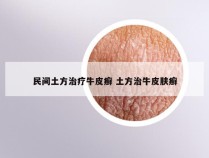 民间土方治疗牛皮癣 土方治牛皮肤癣