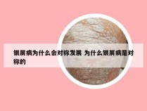 银屑病为什么会对称发展 为什么银屑病是对称的