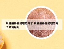 银屑病暴露的地方好了 银屑病暴露的地方好了会留疤吗