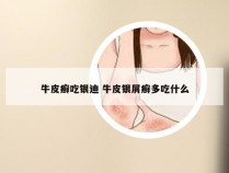 牛皮癣吃银迪 牛皮银屑癣多吃什么