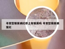 寻常型银屑病红疹上有银屑吗 寻常型银屑病变红