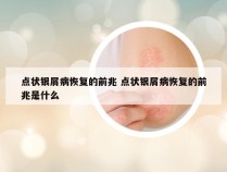 点状银屑病恢复的前兆 点状银屑病恢复的前兆是什么