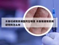 长春权威银屑病医院在哪里 长春银康银屑病研究院怎么样