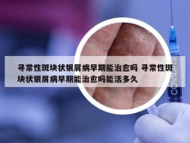 寻常性斑块状银屑病早期能治愈吗 寻常性斑块状银屑病早期能治愈吗能活多久