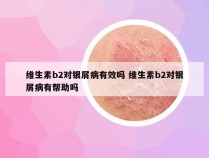 维生素b2对银屑病有效吗 维生素b2对银屑病有帮助吗