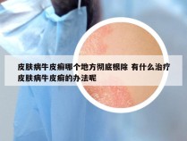 皮肤病牛皮癣哪个地方彻底根除 有什么治疗皮肤病牛皮癣的办法呢